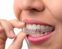Invisalign Results and Vivera Retainers Hornchurch