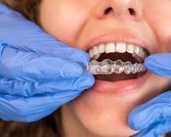 Expert Invisalign Provider Hornchurch Essex RM11